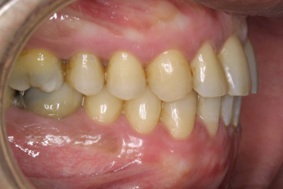 Melanosis_gingivial Melanosis_gingivial