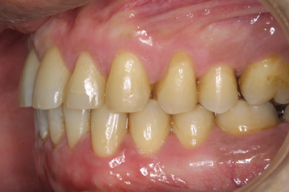 Melanosis_gingivial Melanosis_gingivial