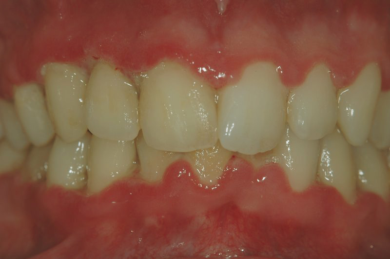 Gingivitis úlcero necrótica aguda antes