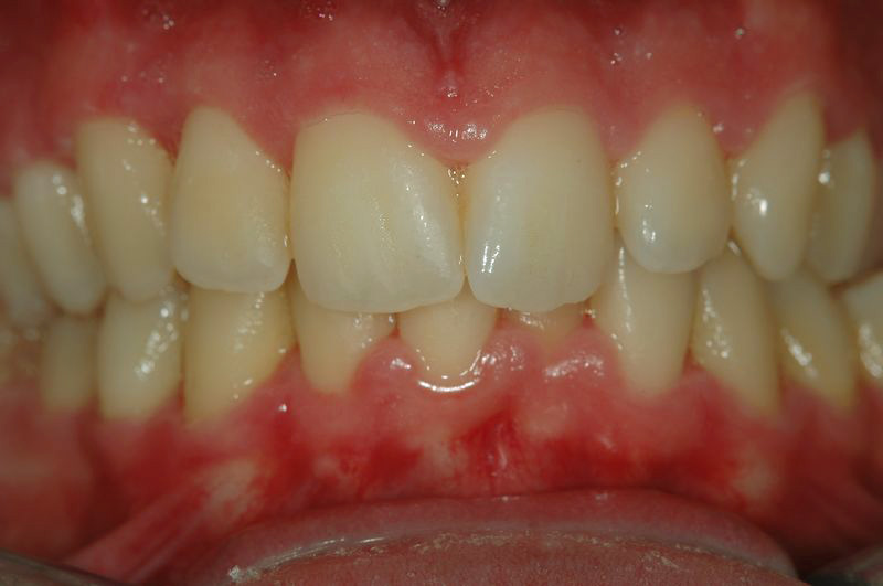 Gingivitis úlcero necrótica aguda antes