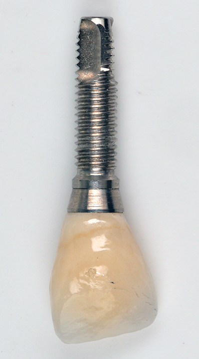 implante dental