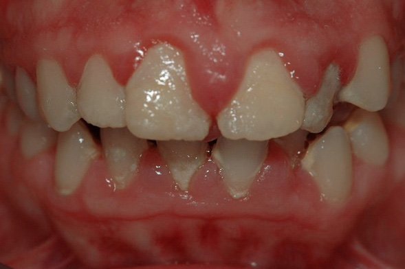Si Comorama hada Infección de encías | Clínica dental en Bilbao