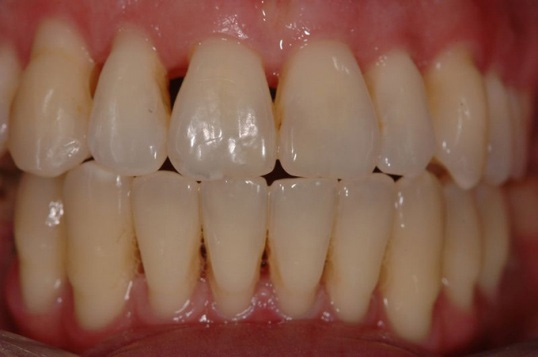 al límite Correlación Deliberadamente Tratamiento de la infección de encías | Clínica dental Bilbao