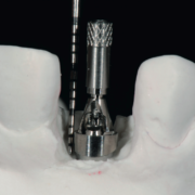 Implantes dentales unitarios