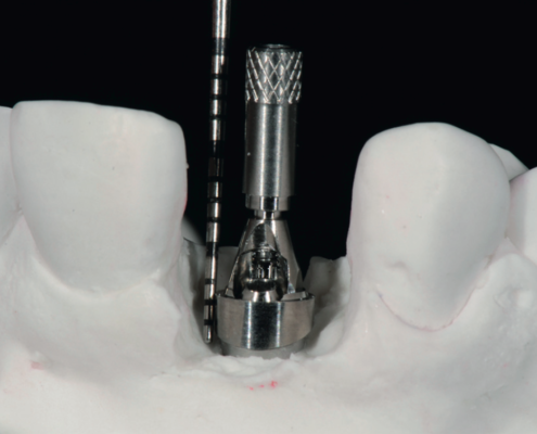 Implantes dentales unitarios