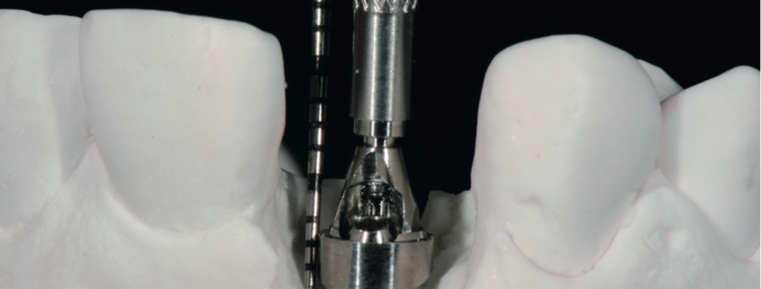 Implantes dentales unitarios