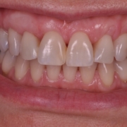 estética periodontal