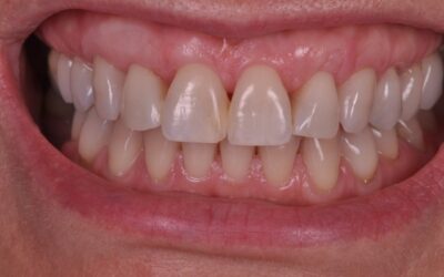 Estética Periodontal
