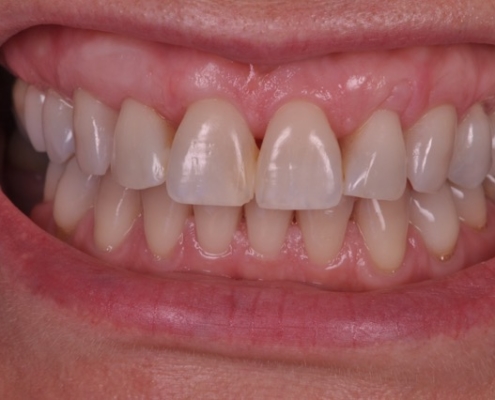 estética periodontal