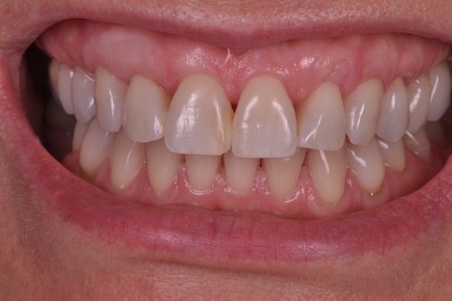 Estética Periodontal