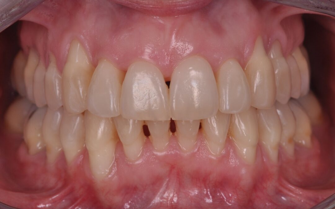 Periodontitis avanzada: Tratamiento del mes