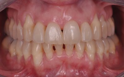 Periodontitis avanzada: Tratamiento del mes