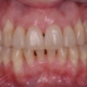 periodontítis avanzada