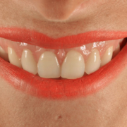 sonrisa gingival