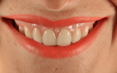 Sonrisa gingival: Tratamiento del mes