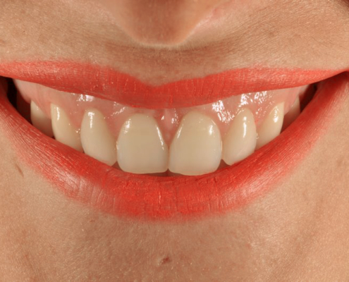 sonrisa gingival