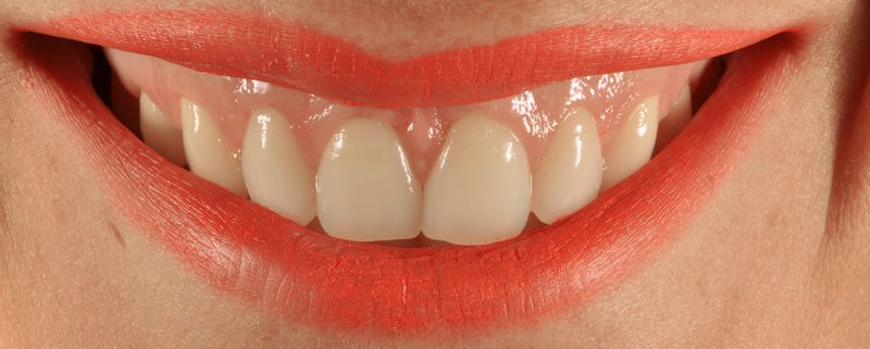 sonrisa gingival