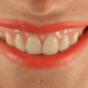 sonrisa gingival