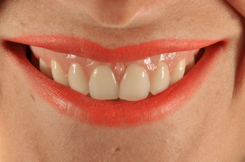 Sonrisa gingival: Tratamiento del mes