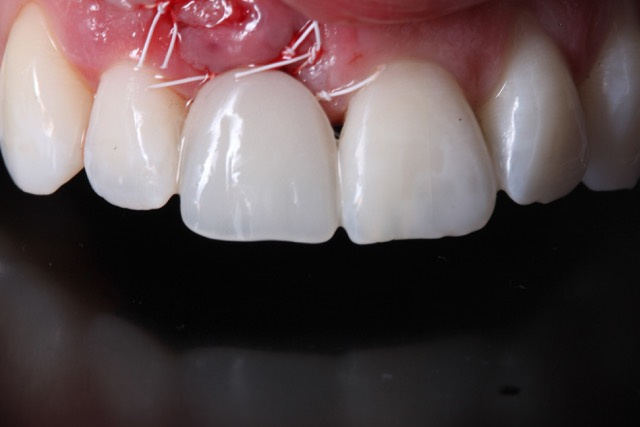 sustitución de incisivo