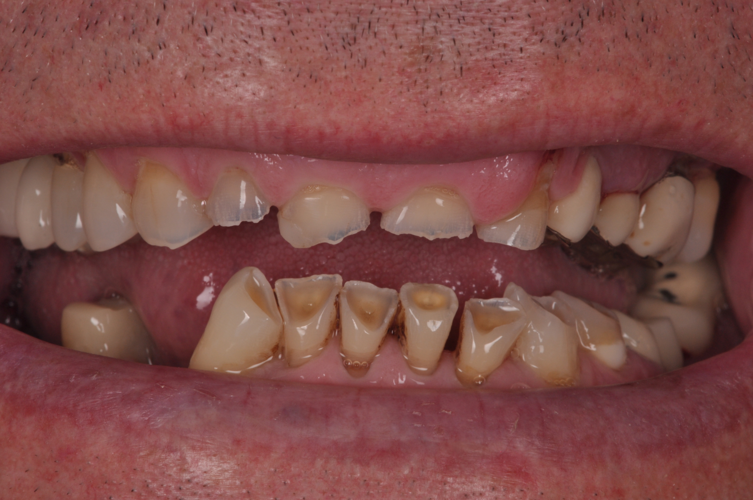 erosiones dentales y apnea