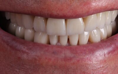 Curso sobre erosiones dentales y apnea