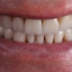 erosiones dentales y apnea