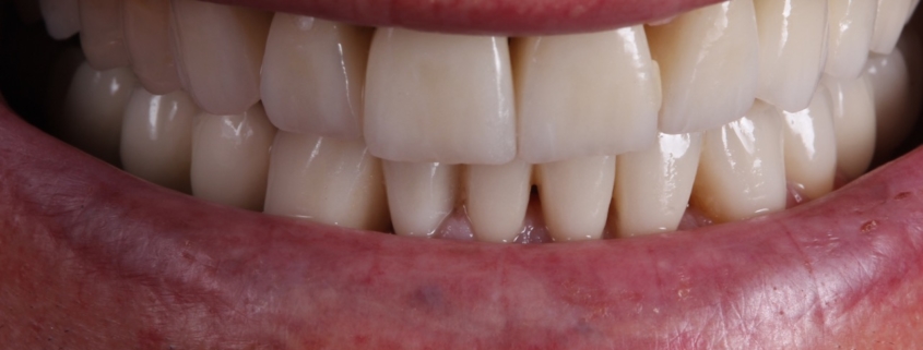 erosiones dentales y apnea