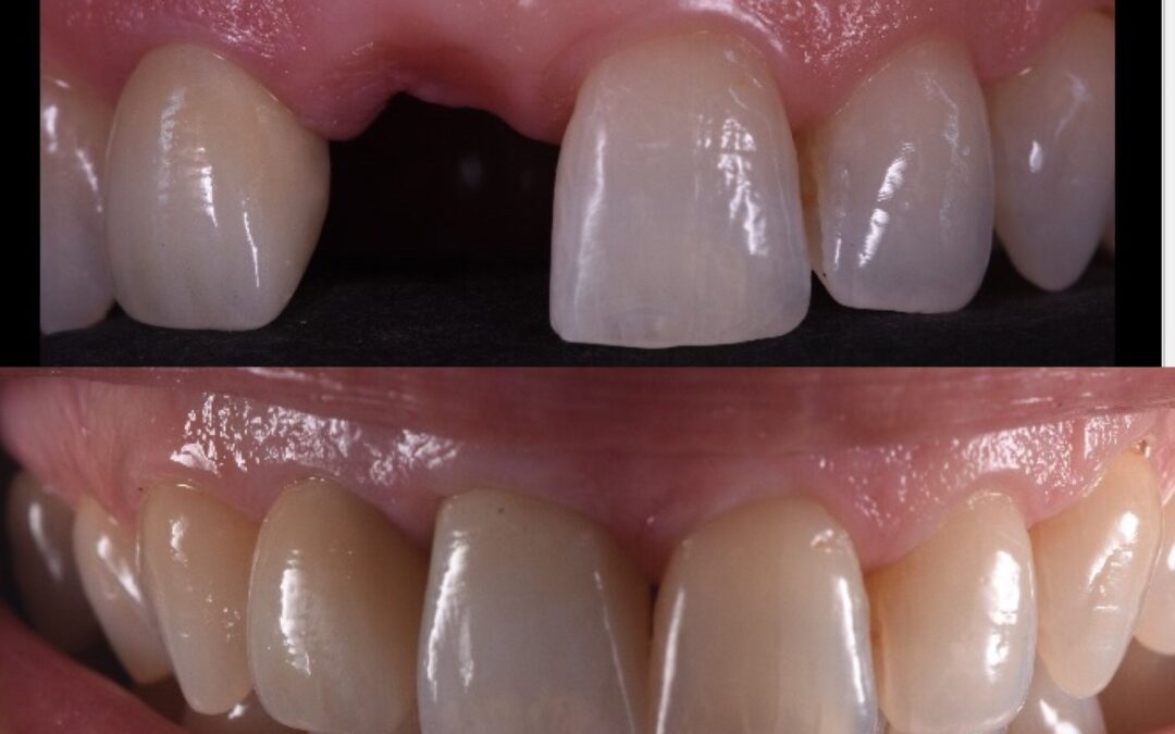 ¿Sabes lo que son los IMPLANTES DENTALES?