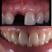 IMPLANTES DENTALES