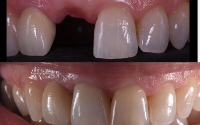 ¿Sabes lo que son los IMPLANTES DENTALES?