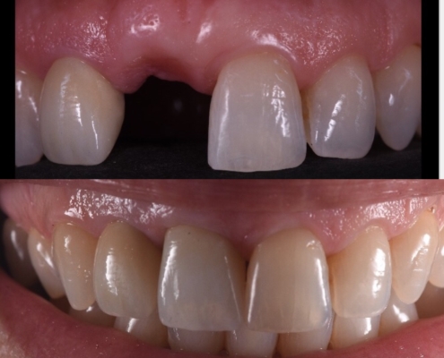 IMPLANTES DENTALES