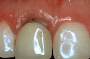 Implantes inmediatos