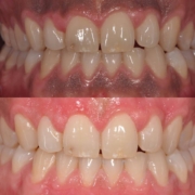 Melanosis Gingival