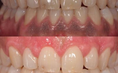 Melanosis Gingival