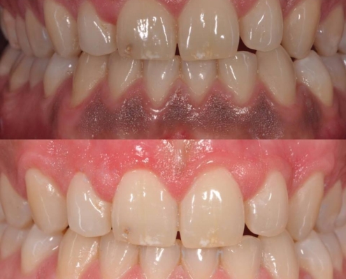 Melanosis Gingival