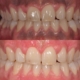 Melanosis Gingival