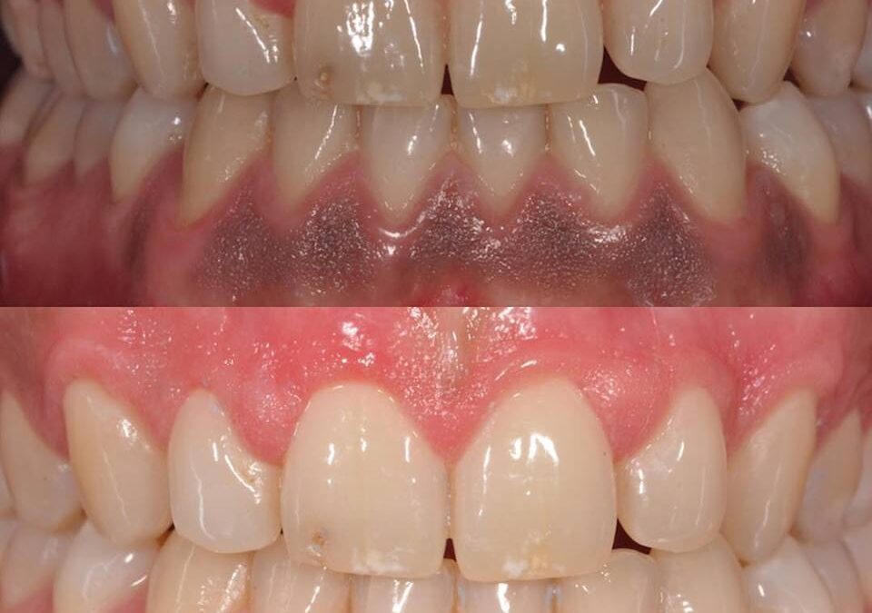 Melanosis Gingival