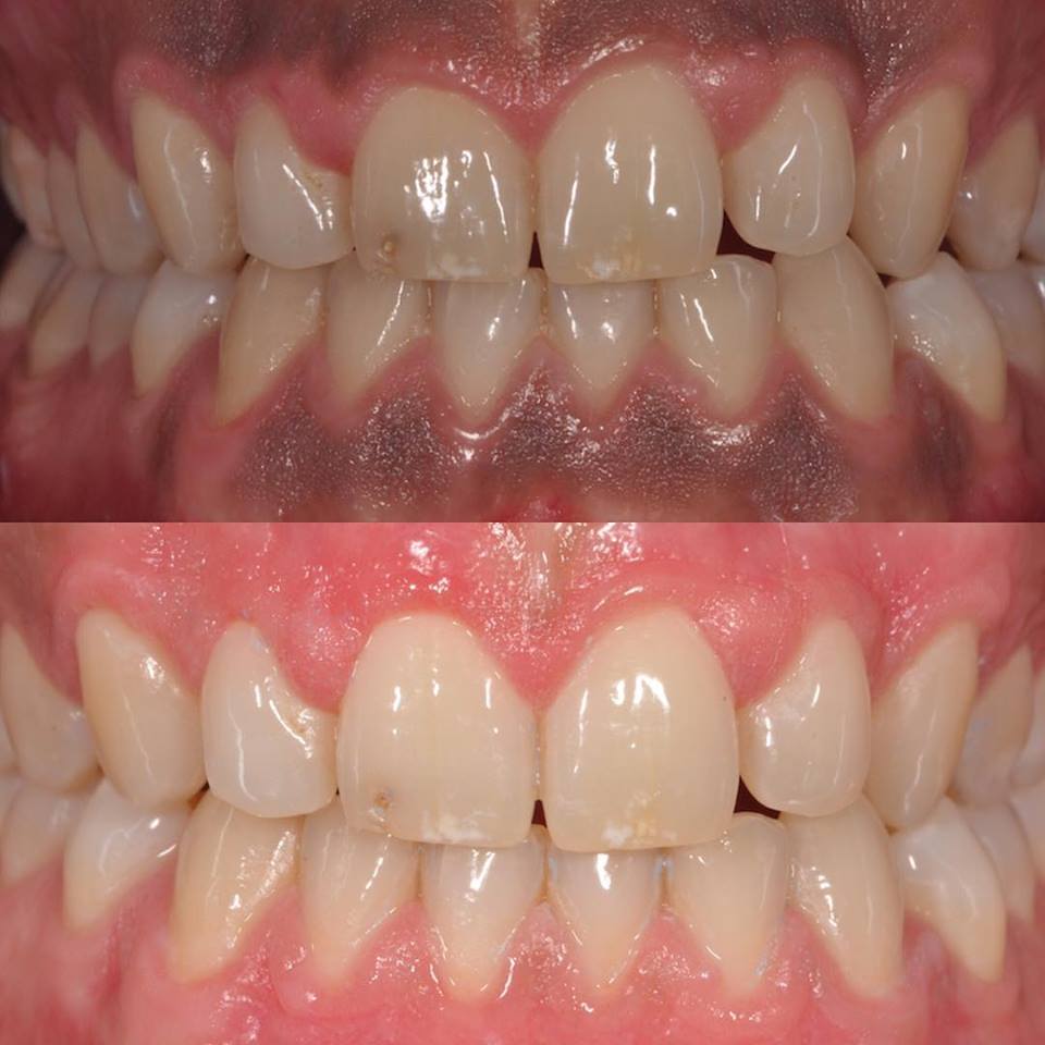 Melanosis Gingival