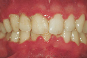 gingivitis aguda