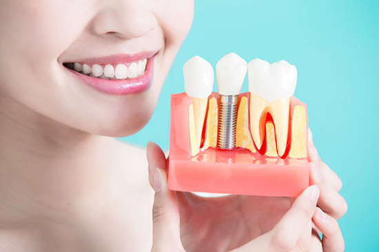 implantes dentales unitarios