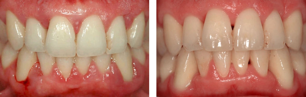 tratamiento periodontal