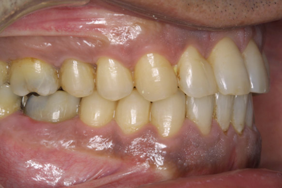 melanosis antes