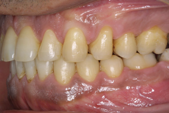 melanosis antes