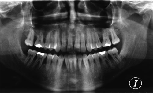 ortopantomografia periodontitis