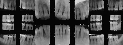 diagnostico periodontitis