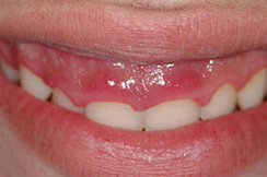 alargamiento dientes cortos-1_antes