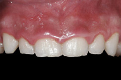 alargamiento dientes cortos-2_antes