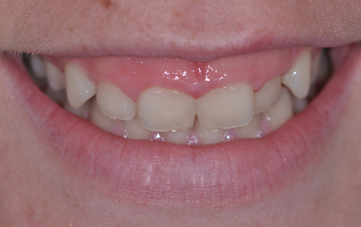 alargamiento dientes cortos-3_antes
