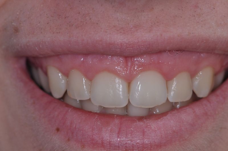 alargamiento dientes cortos-4_antes